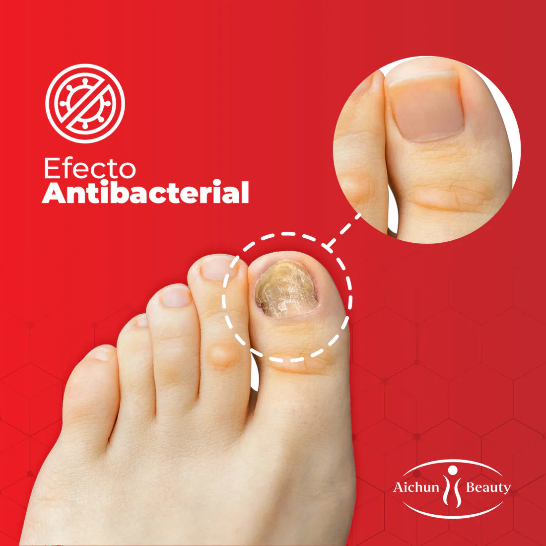 ACEITE PARA ELIMINAR HONGOS EN LOS PIES AichunBeauty ™